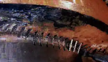 metal stitch